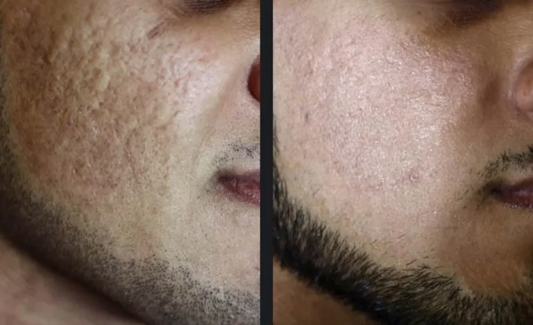 co2re-acne-scar-alain-braun_FKee3tw.jpg