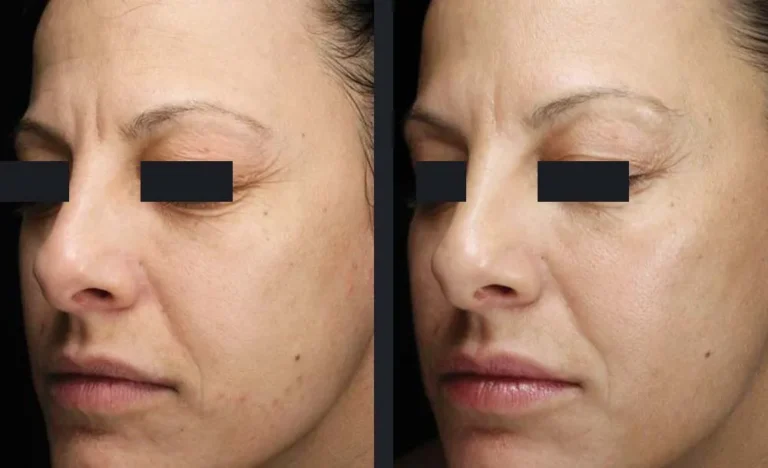 frax-pro-skin-rejuvenation-konica-schallen-md-p7.jpg